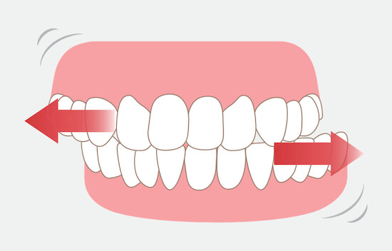 Влияние протезов Perflex на подвижность зубов у людей с бруксизмом